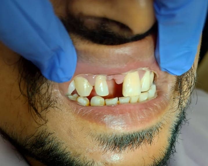 A missing front tooth, closed with a bridge, before treatment